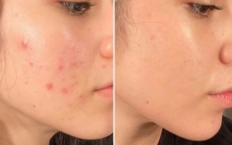 Dùng serum rau má bao lâu thì xẹp mụn? dung serum rau ma bao lau thi xep mun