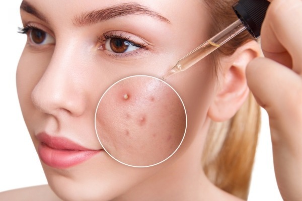 Dùng serum rau má bao lâu thì xẹp mụn? dung serum rau ma bao lau thi xep mun