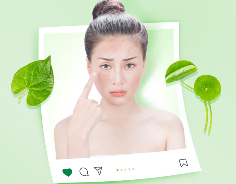 Rau má hỗ trợ giải quyết các vấn đề về da