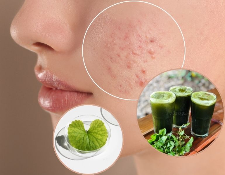 Trị thâm mụn bằng rau má